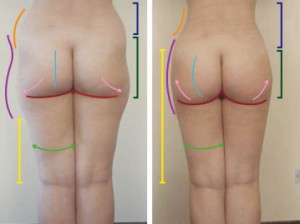 Two side-by-side photos highlight body contours after body sculpting, with colored lines marking changes in the waist, hips, thighs, and buttocks—showcasing transformation through cosmetic surgery Texas.